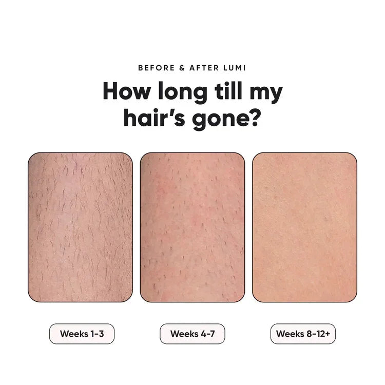 LaxeHaven before and after Lumi hair removal progress on skin, shown over weeks 1–12+