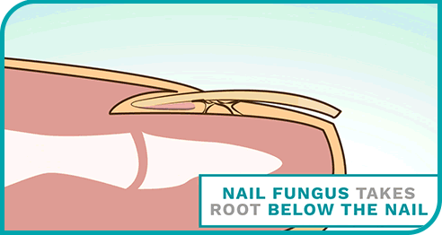 Nail Fungus Spray|Specially For UAE|