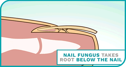 Nail Fungus Spray|Specially For UAE|