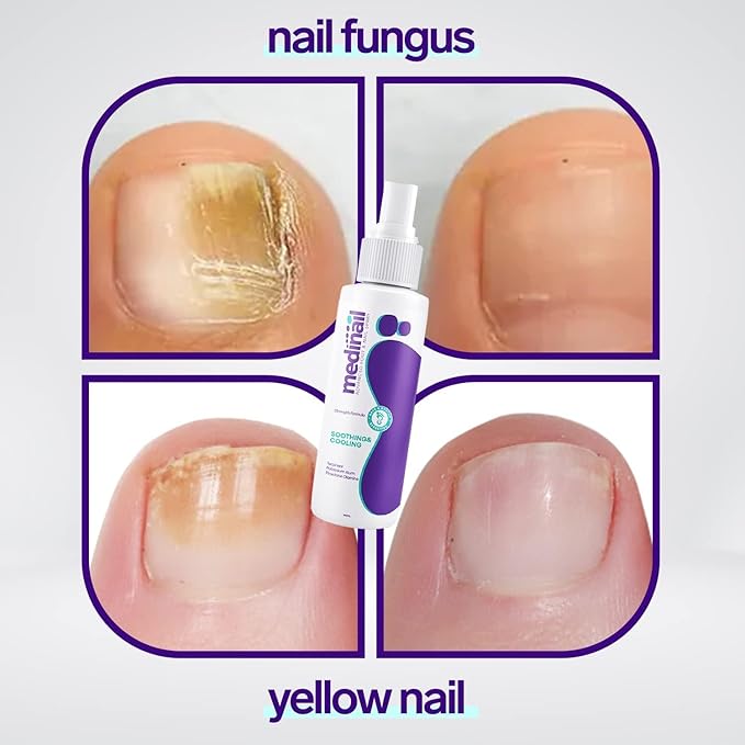 Nail Fungus Spray|Specially For UAE|