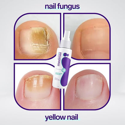 Nail Fungus Spray|Specially For UAE|